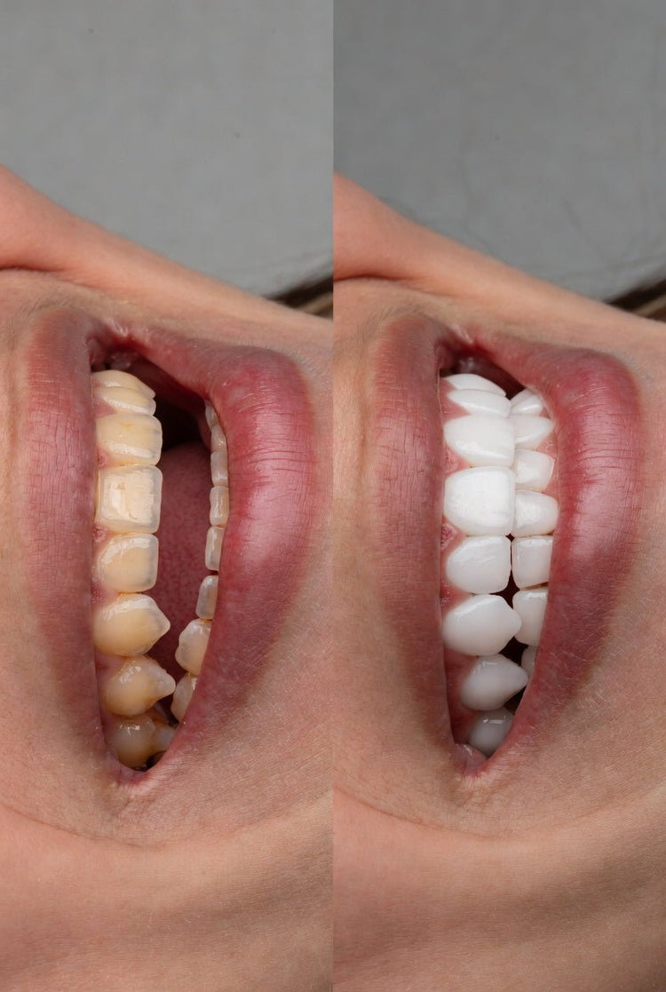Whitening Strips Before and After - OrellaUV