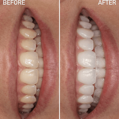 5D Whitening Strips - OrellaUV